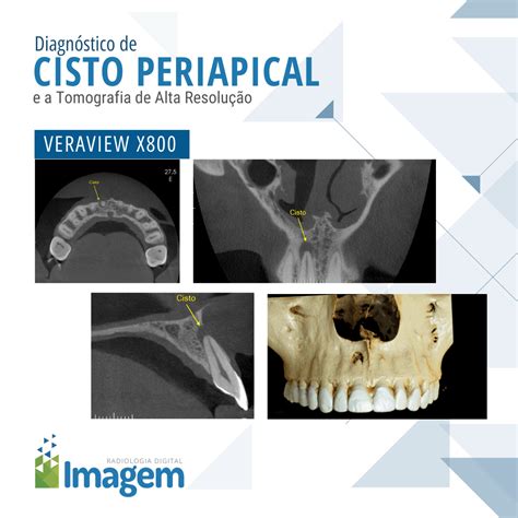 Cisto Periapical é Grave