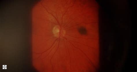 Sonoran Desert Eye Center Brown Spot On Retina