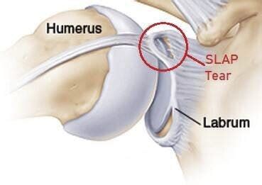 What Is Slap Lesion
