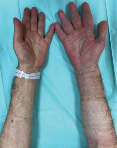 Unilateral Swelling And Functional Impairment Of Unknown Origin In The