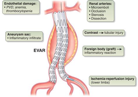 Endovascular Aneurysm Repair Evar And Transcatheter Aortic Valve