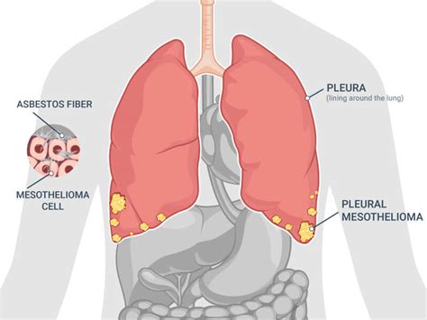 Mesothelioma Symptoms And Treatment Worldwide Tweets
