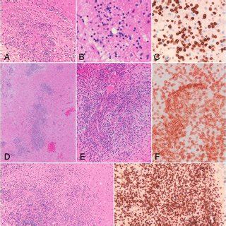 The appearance of clippers on mri is fairly unique, characterized by multiple punctate, patchy and linear regions of contrast enhancement relatively confined to the pons 1 clippers syndrome. Characteristic pontine-predominant MRI characteristics of ...