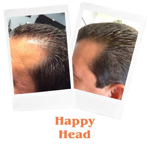 Finasteride For Hair Loss Results Propecia Finasteride Hair