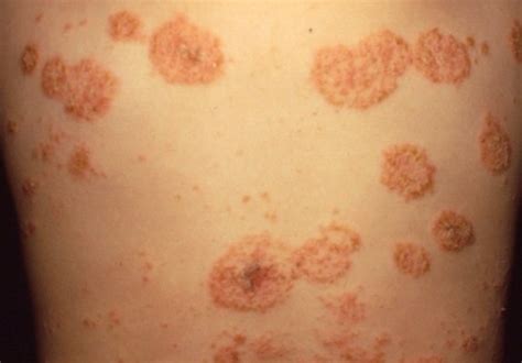 Dermatitis Numular Penyebab Gejala Dan Cara Mengatasi