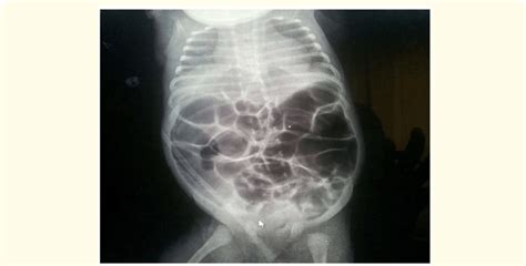 Abdominal X Ray Showing Abdominal Distention With Multiple Dilated