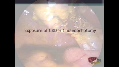 Laparoscopic Cholecystectomy And Common Bile Duct Exploration Youtube