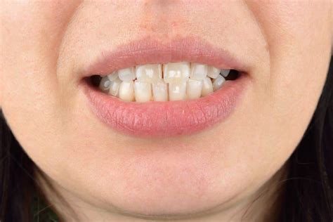 How To Get Rid Of White Spots On Teeth Fab How