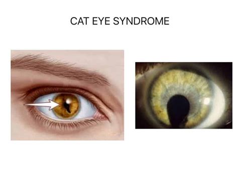 What Is Cat Eye Syndrome Heres What The Science Says