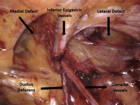 Triple Inguinal Hernia Rare Clinical Presentation Bmj Case Reports