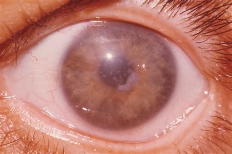 Corneal Disease Ophthalmologist Eye Physician Surgeon