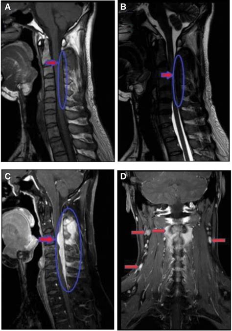 Cervical Spine Rosaidorfman Disease A Case Report And Lite Medicine