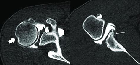 Ct Arthrography Of The Right Shoulder In A 24 Year Old Male Patient