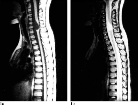 Figure 1 From Mr Imaging Characteristics Of Cervical Neurenteric Cysts