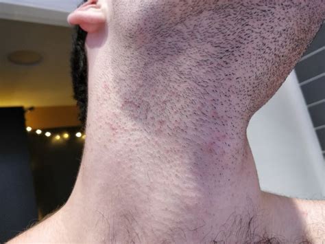 How To Get Rid Of Bumps On Neck After Haircut Style Trends In 2023