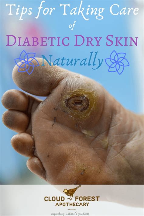 Tips For Taking Care Of Diabetic Dry Skin Naturally Leg Ulcers Dry