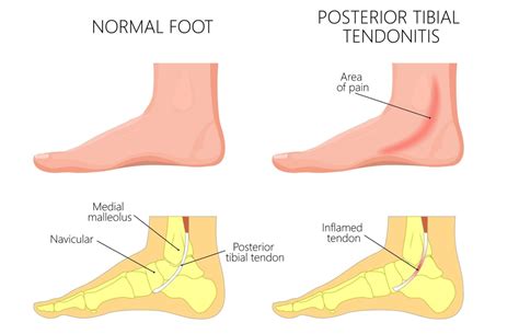 Posterior Tibial Tendonitis Caruso Foot And Ankle