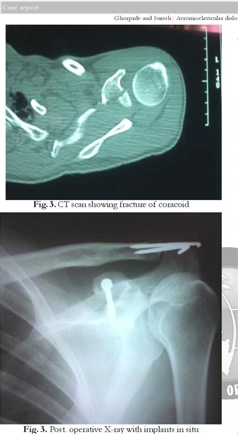 Figure 3 From Acromioclavicular Dislocation With Avulsion Fracture Of