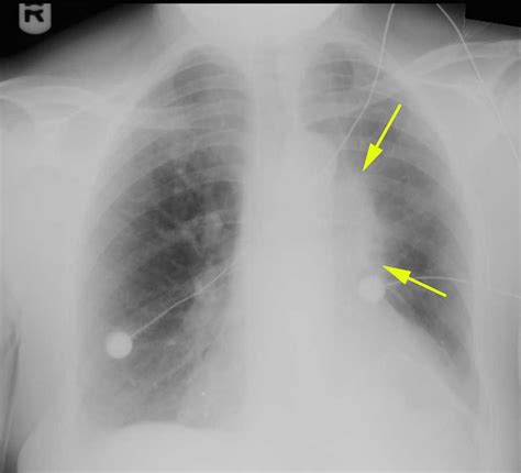 Left Upper Lobe Atelectasis On Chest X Ray X Rays Case Studies