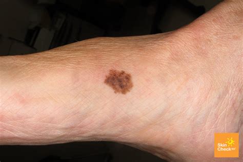 Did You Know You Can Get Malignant Melanoma On Your Feet Sutherland