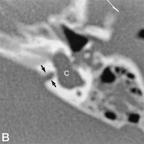 Ct Appearance Of Normal Cochlear Aqueduct Axial A And Coronal B