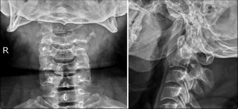 Plain X Ray Cervical Spine Showing An Ill Defined Lytic Lesion In C2