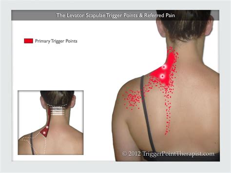 Levator Levator Scapula Trigger Points And Referred Pain