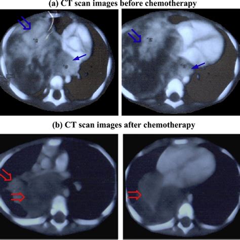Illustrative Ct Scan Images Of The Chest Region Showing The Ppb Tumor