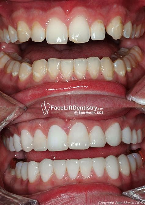 An overbite can be fixed without braces. Overbite Correstion Without Braces