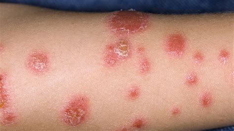 Five Biologics Perform Strongly In Children With Psoriasis