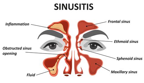 Steam For Sinuses Discount Collection Save 52 Jlcatjgobmx