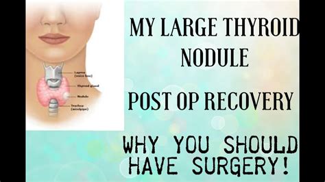 Weeks Post Op Recovery From Partial Thyroidectomy After Having A