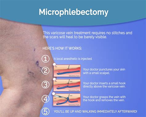 Microphlebectomy Aloha Vein
