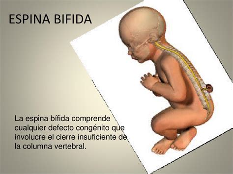Espina Bifida By Carlos Cortes Issuu