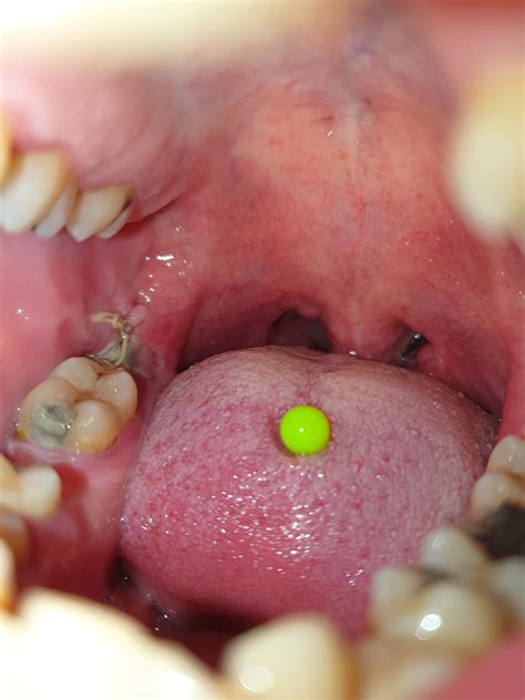 Canker Sores After Wisdom Tooth Extraction
