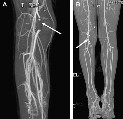 Figure 22 From Ct Angiography Of The Lower Extremities Semantic Scholar