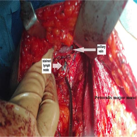 Example Of Axillary Lymph Node Dissection For This Patient The Total