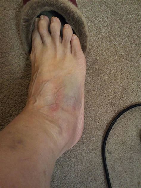 Bruised Swollen Foot Flickr Photo Sharing
