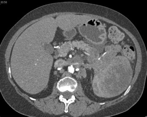 Splenic Lymphoma With Pancreatic Lesions As Well Spleen Case Studies