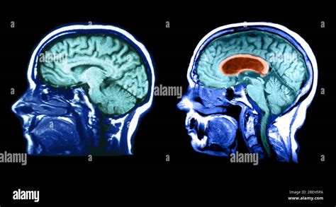 Mri Of Normal Brain And Hydrocephalic Brain Stock Photo Alamy