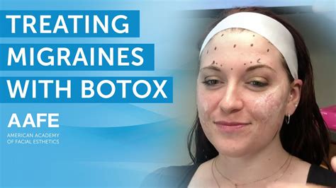 Using Botox To Treat Migraines After Years Of Pain Aafe Youtube