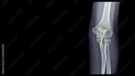 Film X Ray Elbow Radiograph Show Elbow Bone Broken Proximal Ulna Or