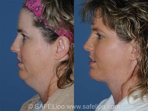 Double Chin Reduction Before And After Pictures Case 350 Safelipo®