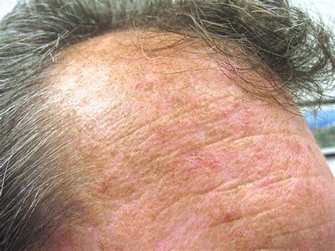 What Are The Treatment Options For Actinic Keratosis
