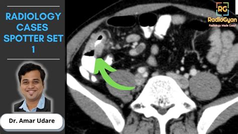 Radiology Cases Spotters Set 1 Quiz And Discussion Live Youtube