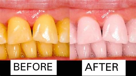 The top results are going to be talking about orange and banana peel and how to use. How To Whiten Your Teeth Naturally At Home Quickly & Instantly