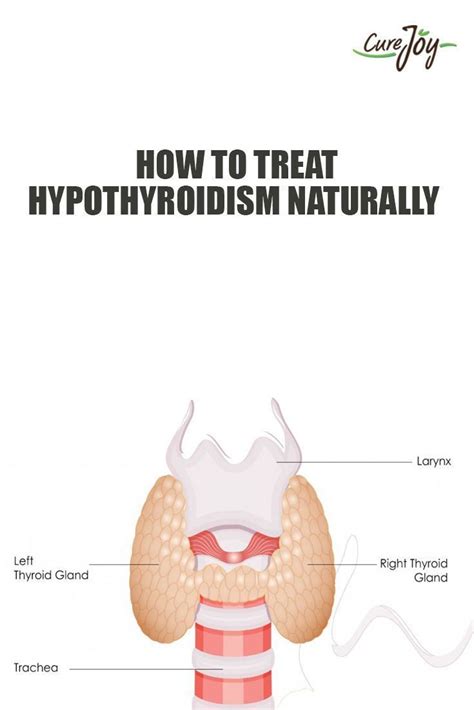 How To Treat Hypothyroidism Naturally With Images Hypothyroidism