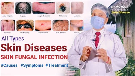 Skin Fungal Infection Causes Symptoms Herbal Treatment चर्म रोग Skin