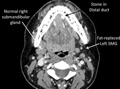 Salivary Gland Atrophy With Chronic Obstruction Iowa Head And Neck