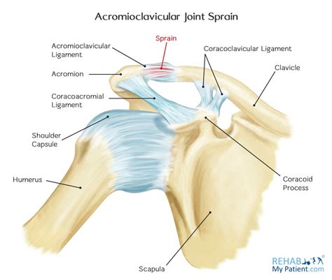 Acromioclavicular Joint Sprain Rehab My Patient
